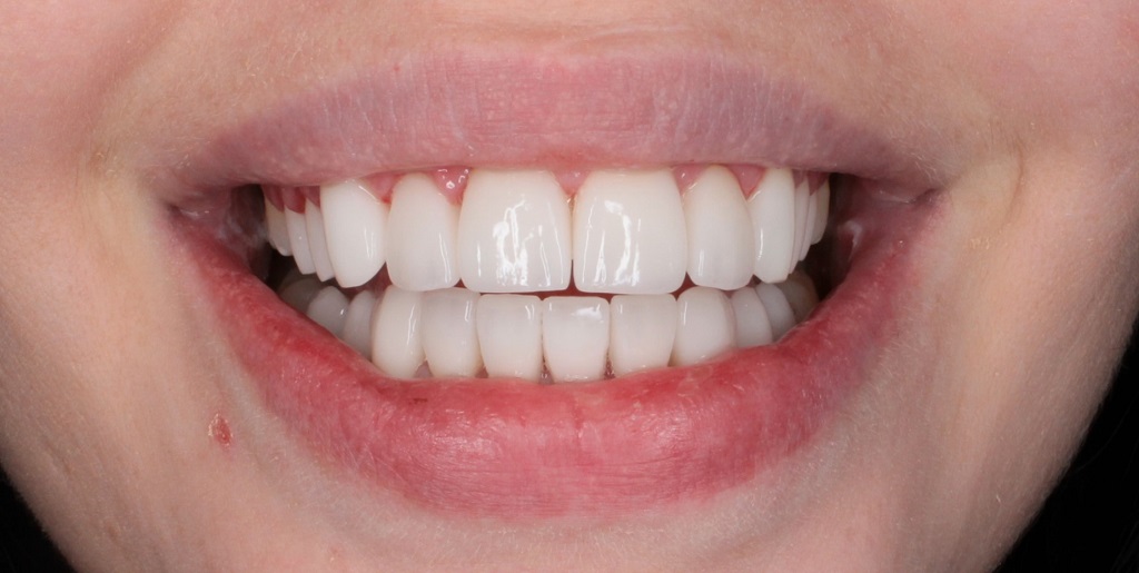 Керамические виниры