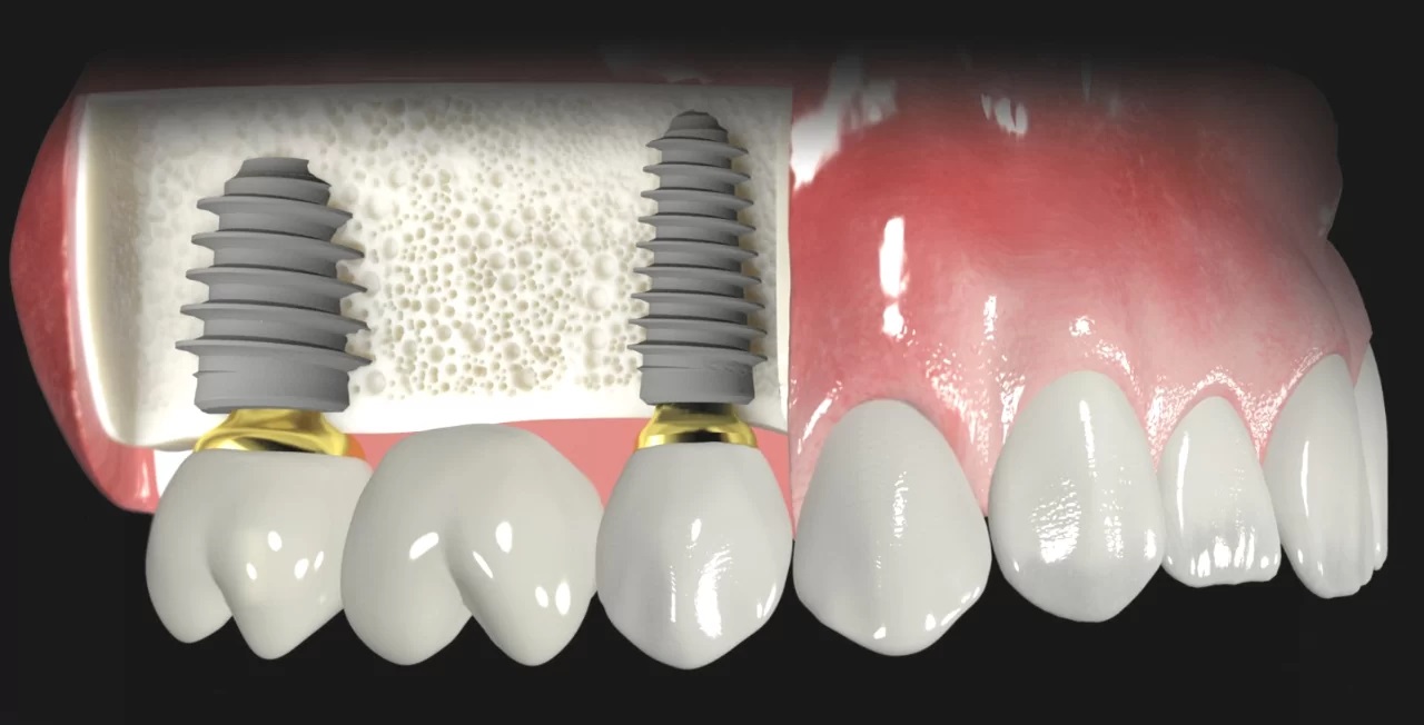 Плюсы и минусы операции быстрой имплантации, возможные осложнения