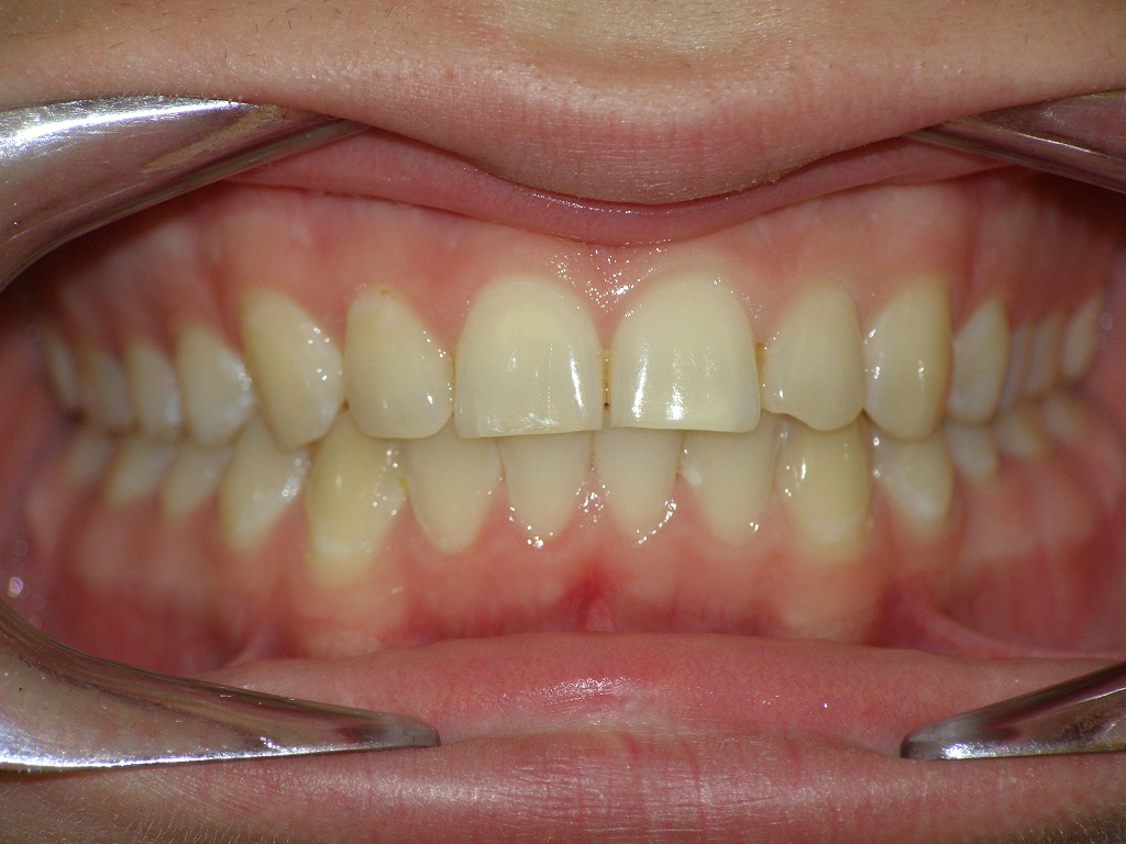 Исправление прикуса