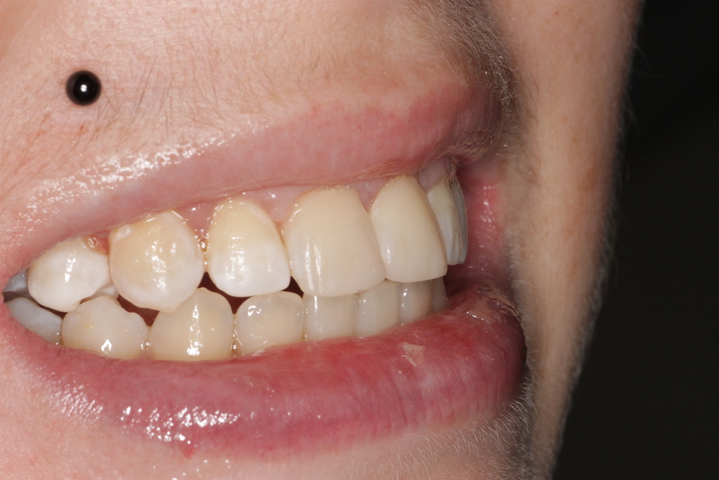 Художественная реставрация зубов