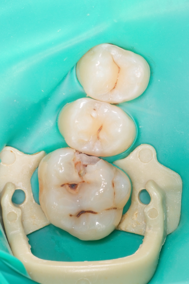 Лечение кариеса