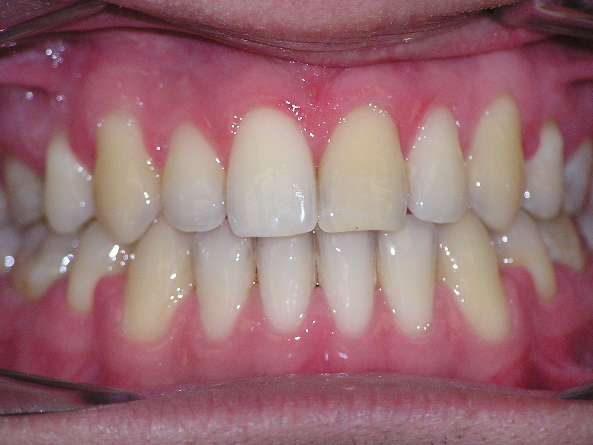 Исправление прикуса брекетами