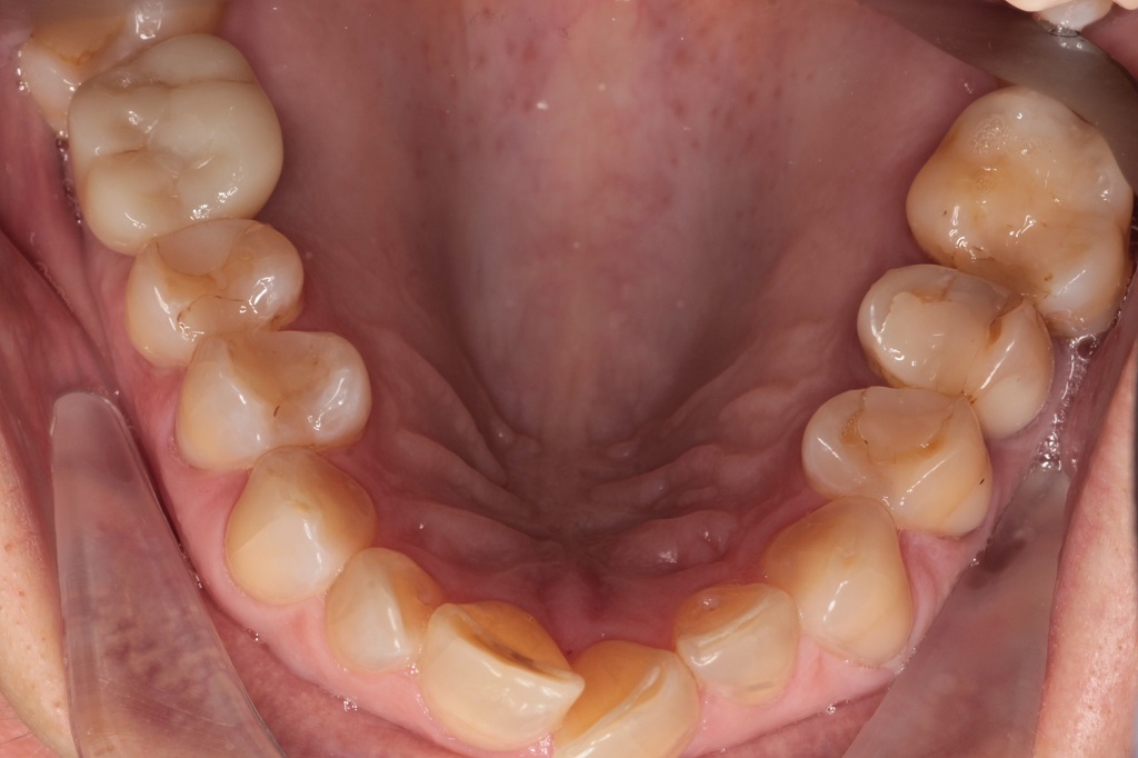 Установка имплантата