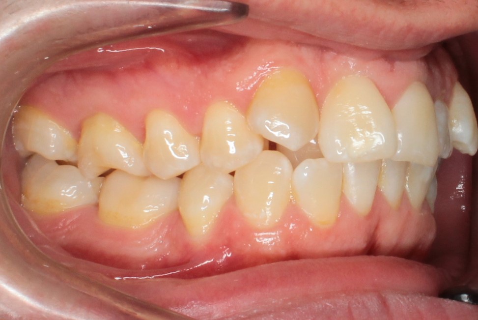 Исправление прикуса брекетами