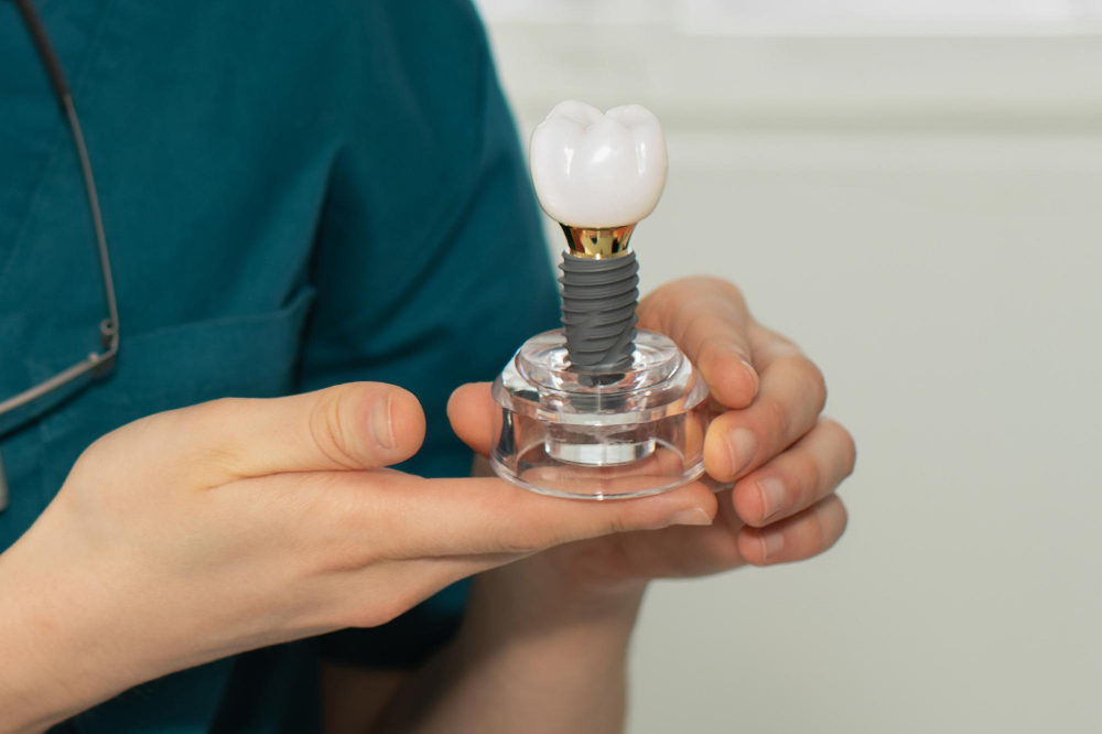 Сколько служат зубные имплантаты