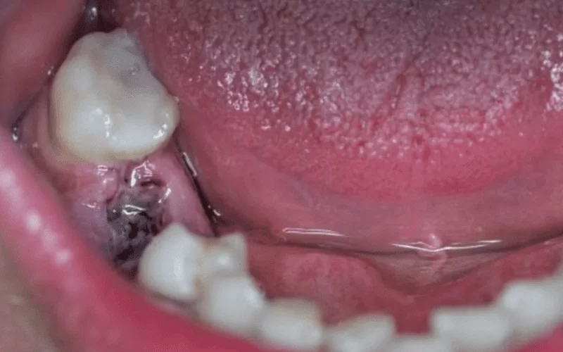 Альвеолит после удаления зуба - симптомы и лечение