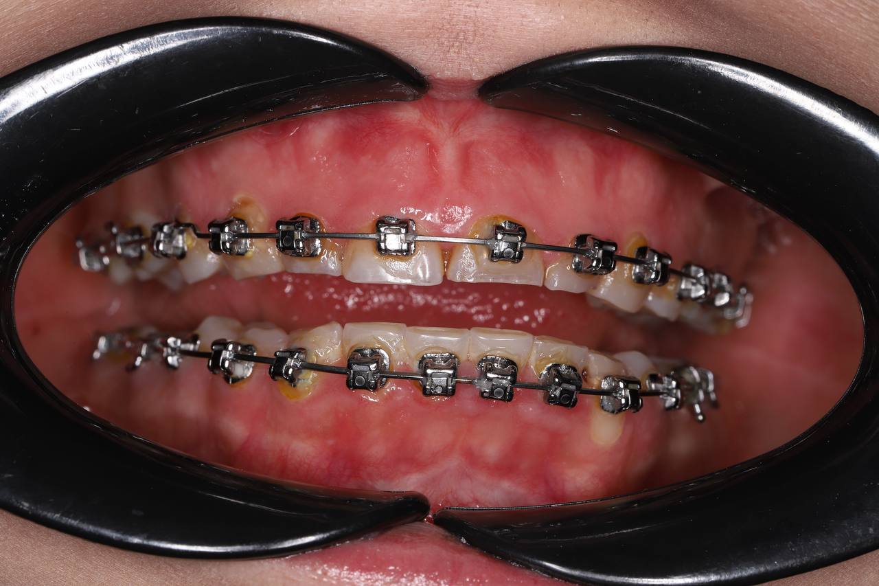 Удлинение клинической коронки зуба