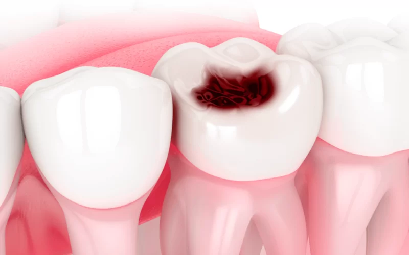 Почему разрушается эмаль зубов и что с этим делать