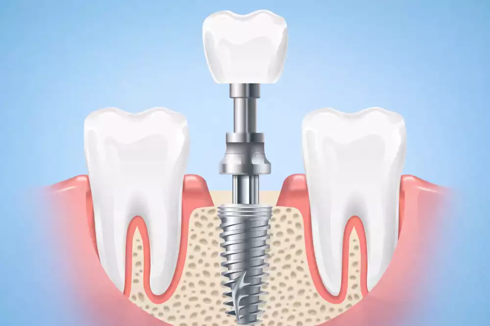 Рейтинг зубных имплантов: сравнение систем и какие импланты выбрать