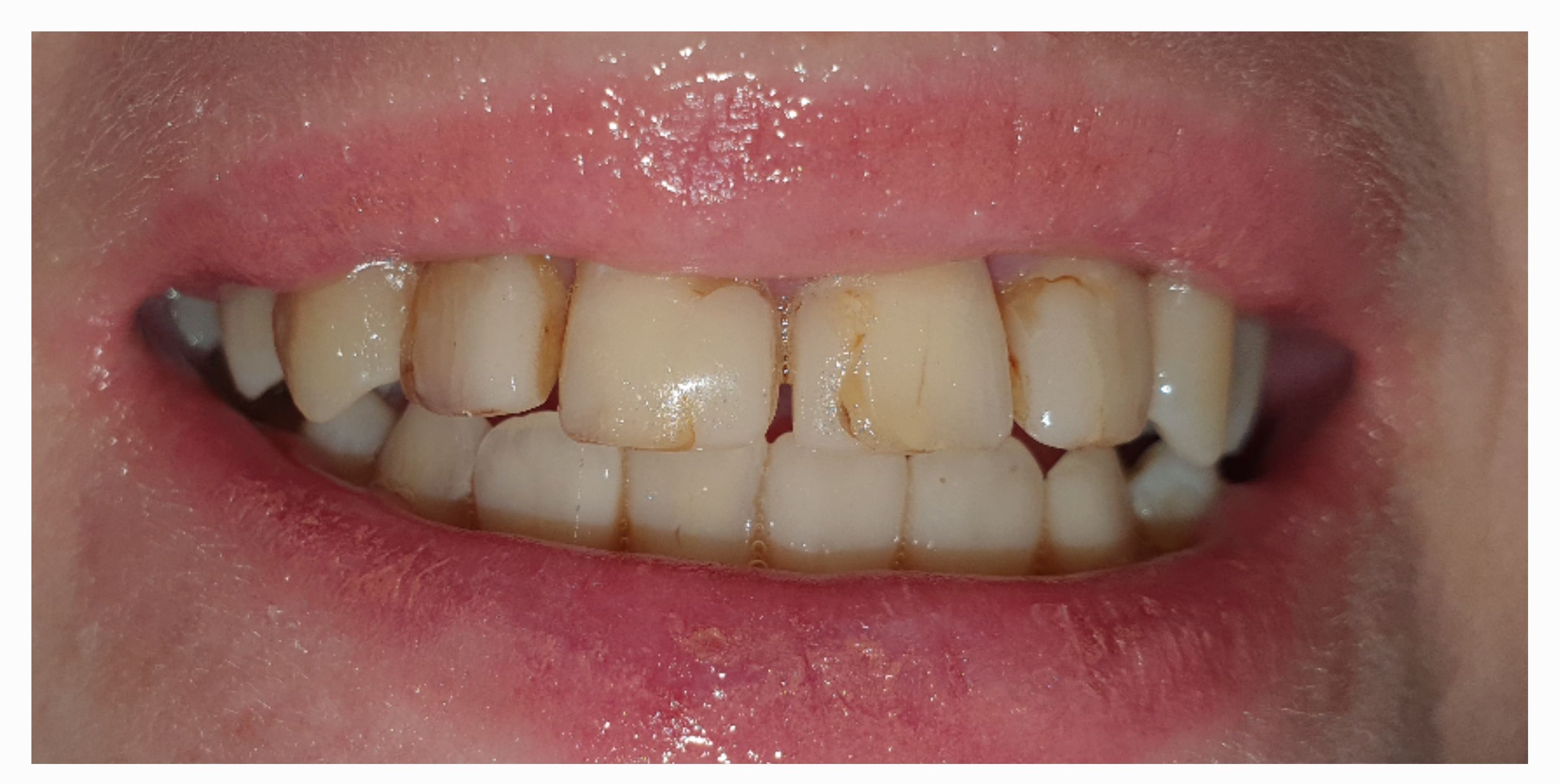 Композитные виниры