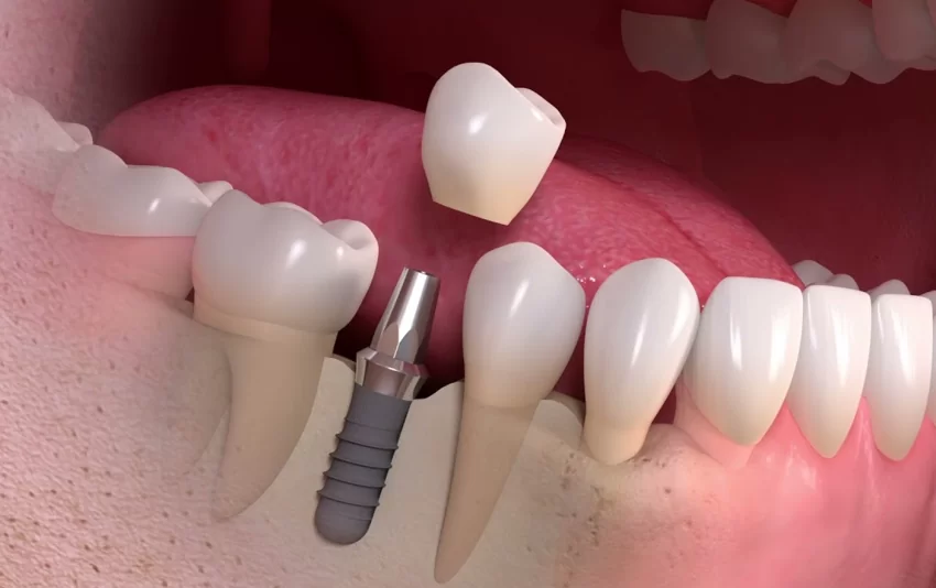 Рекомендации после имплантации зубов