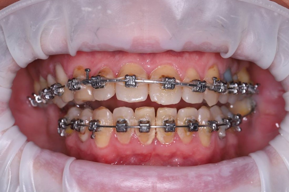 Лечение пародонтита