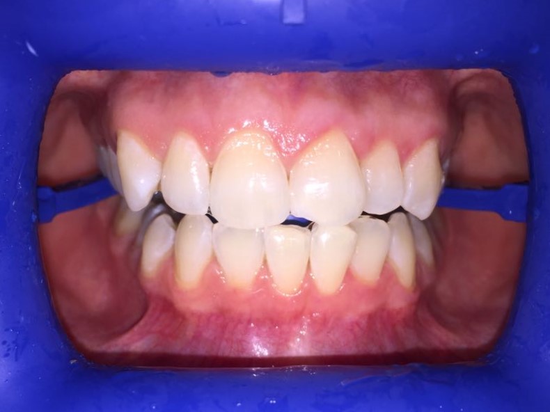 Отбеливание