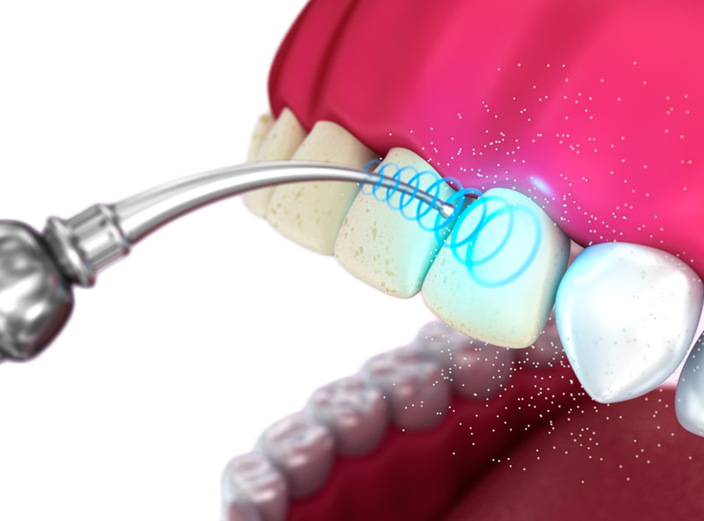 Ультразвуковая чистка зубов