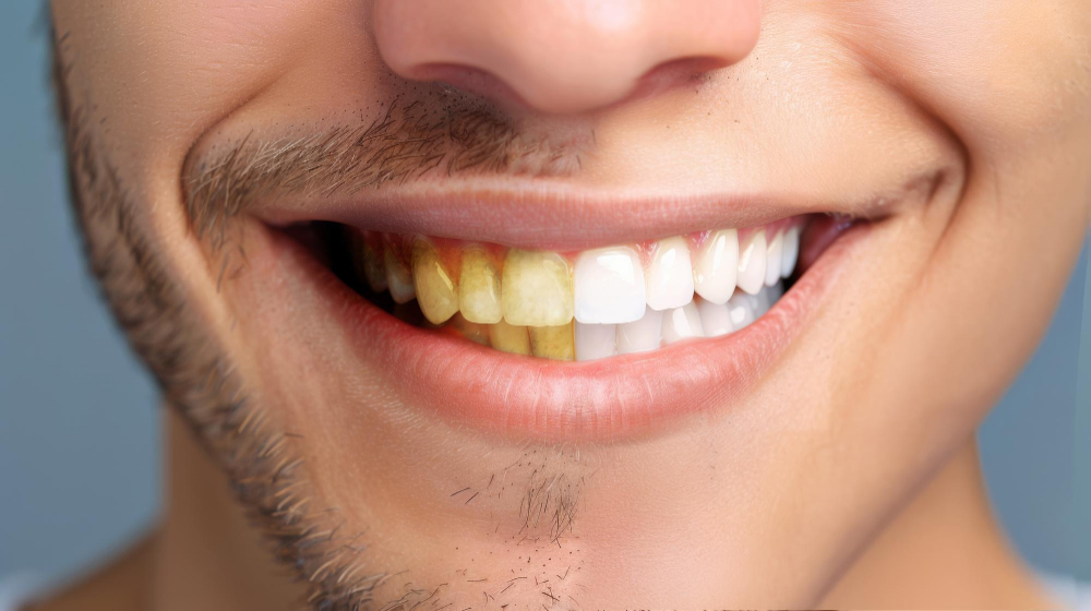 Желтые зубы: налет и пятна желтого цвета на зубах
