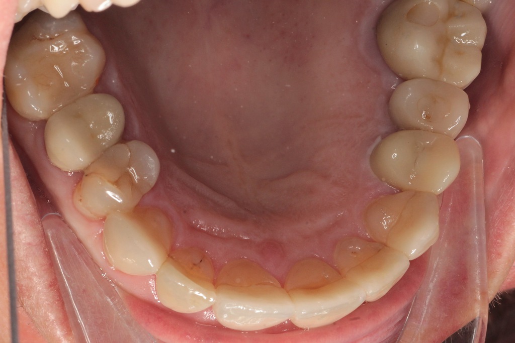 Металлокерамические коронки