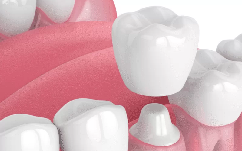 Чем отличается протезирование от имплантации зубов