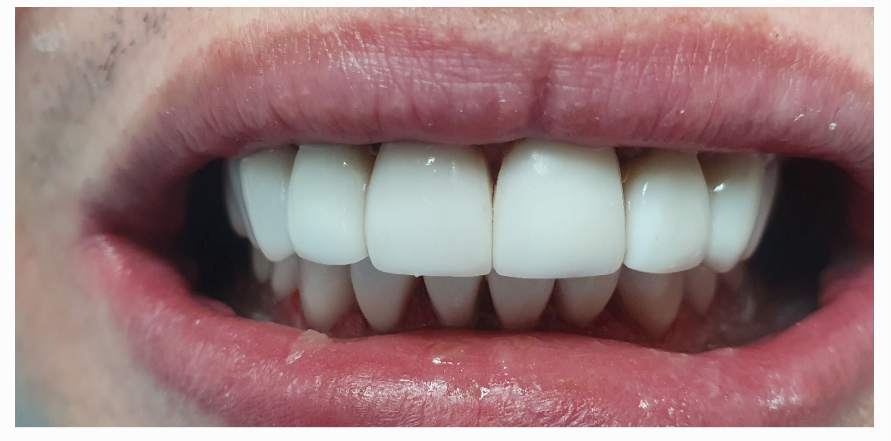 Композитные виниры