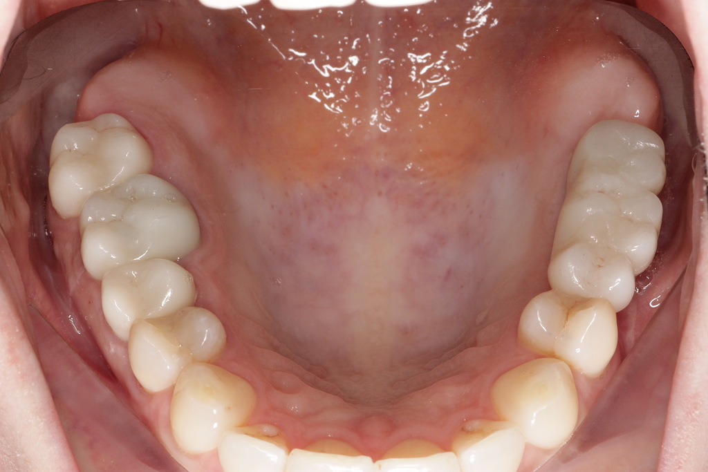 Коронки из диоксид циркония