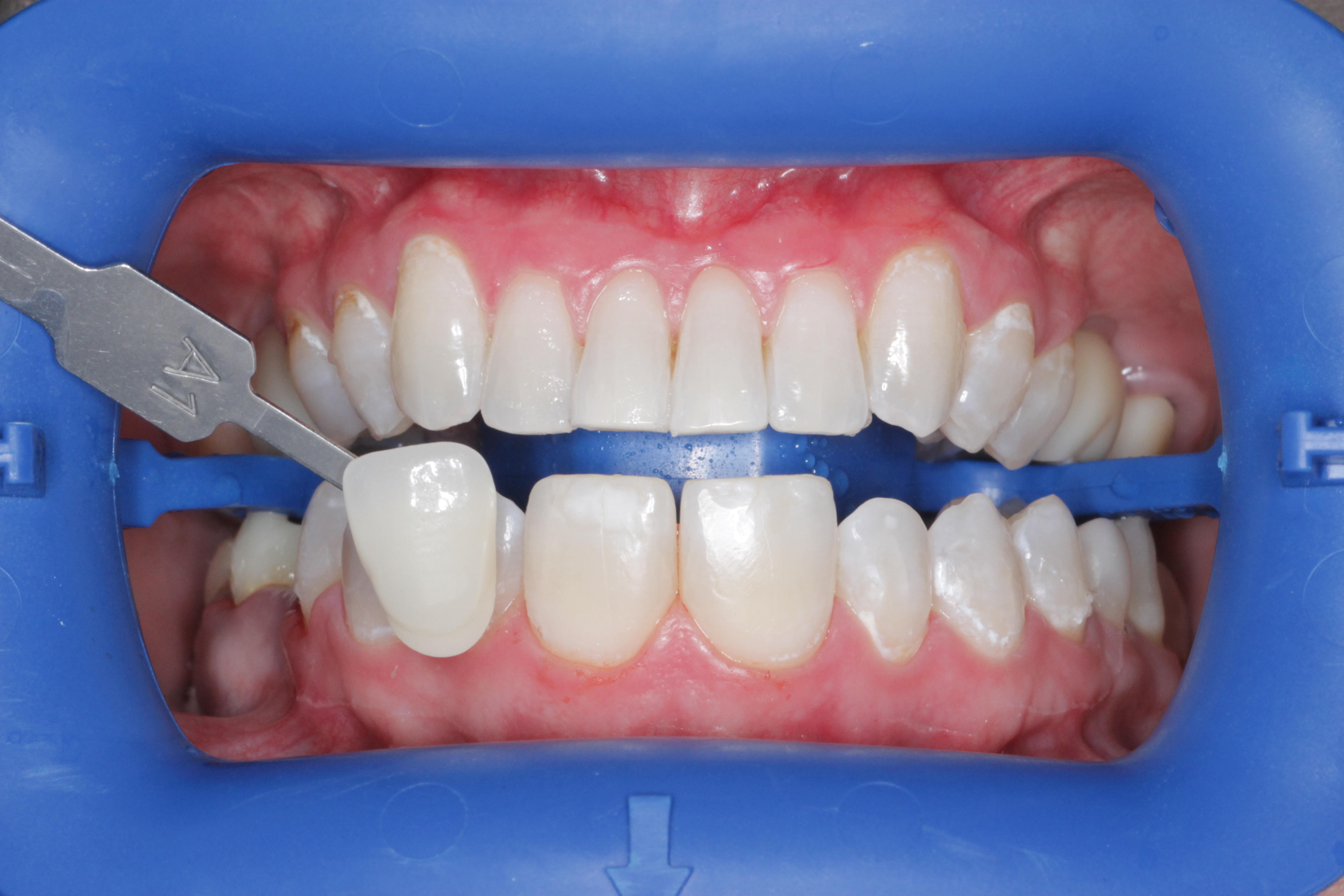 Отбеливание