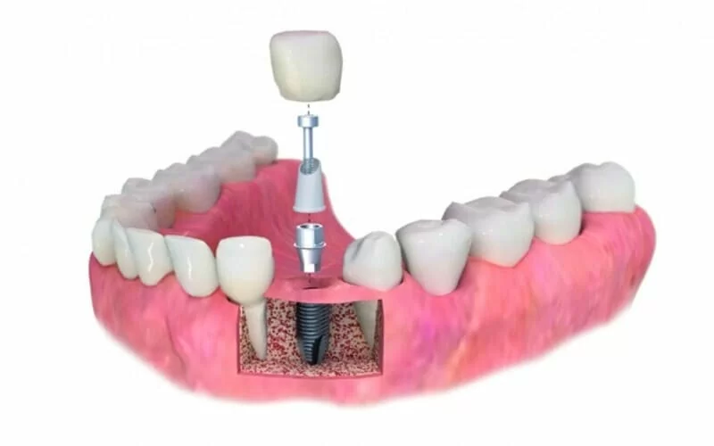 Имплантация сразу после удаления зуба