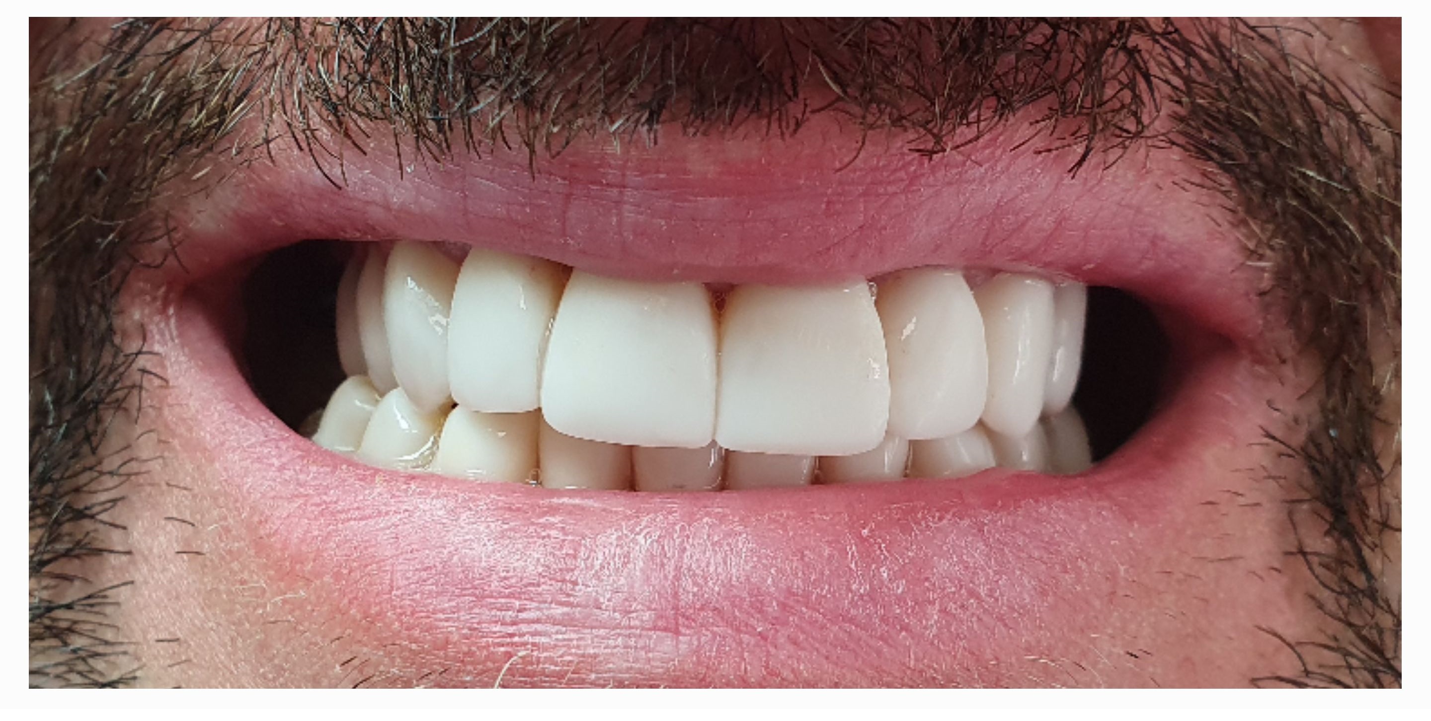 Композитные виниры