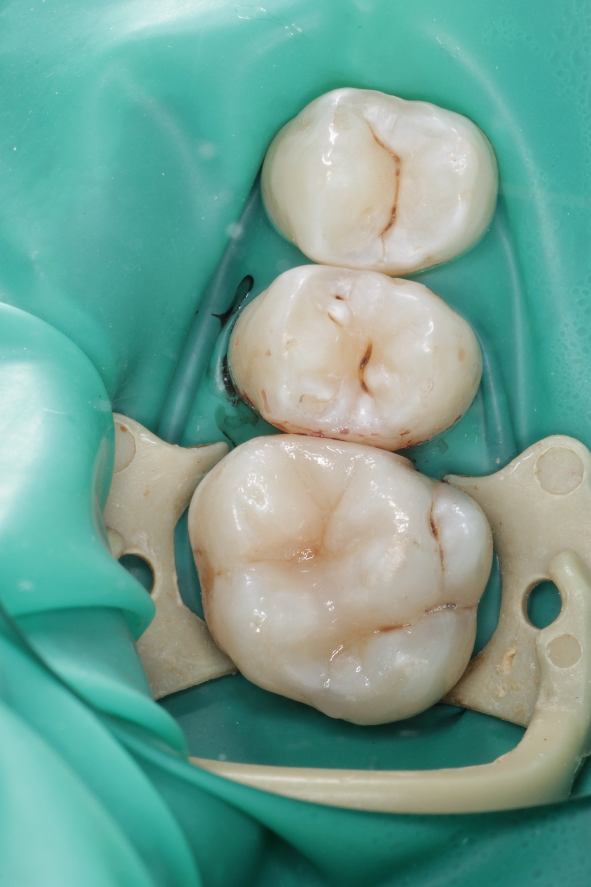 Лечение кариеса