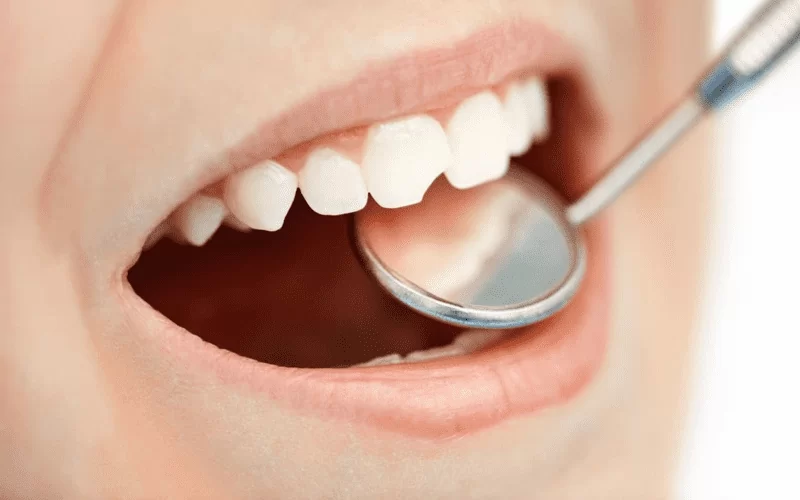 Откололся зуб: что делать и как восстановить повреждение?