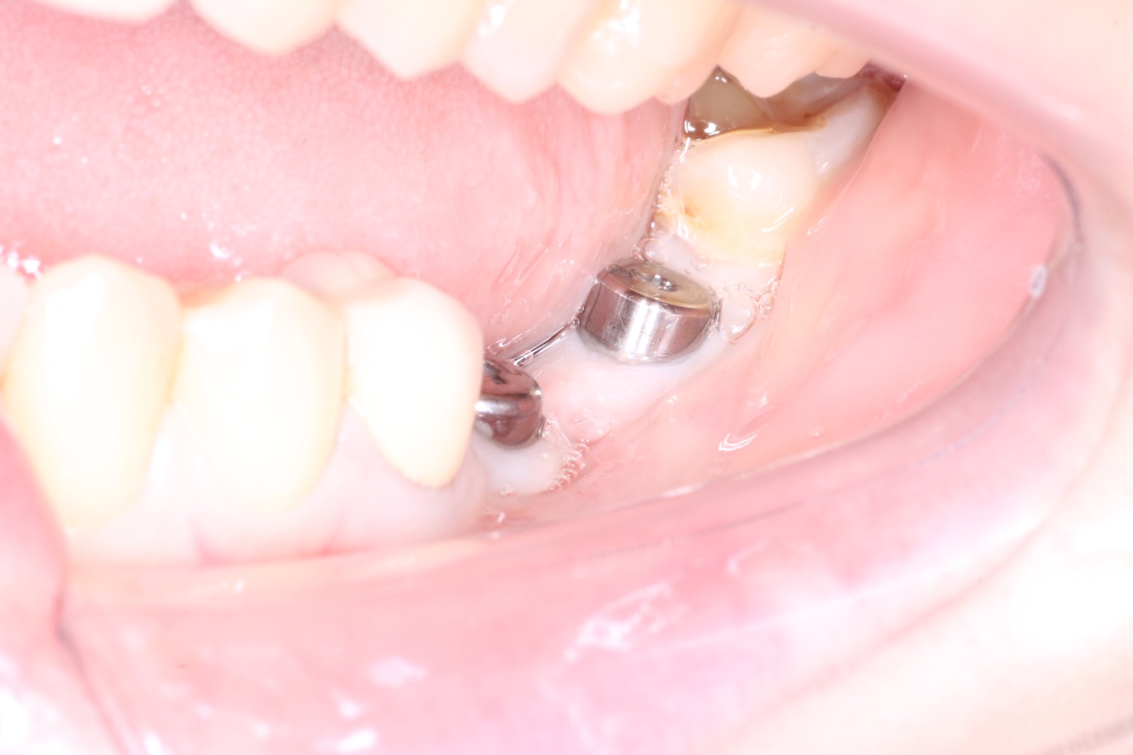 Десневая пластика в области имплантатов