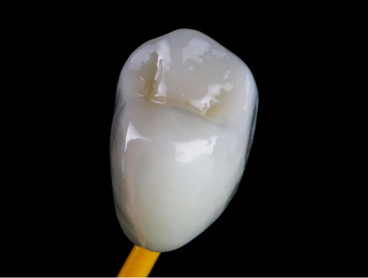 Металлокерамические коронки