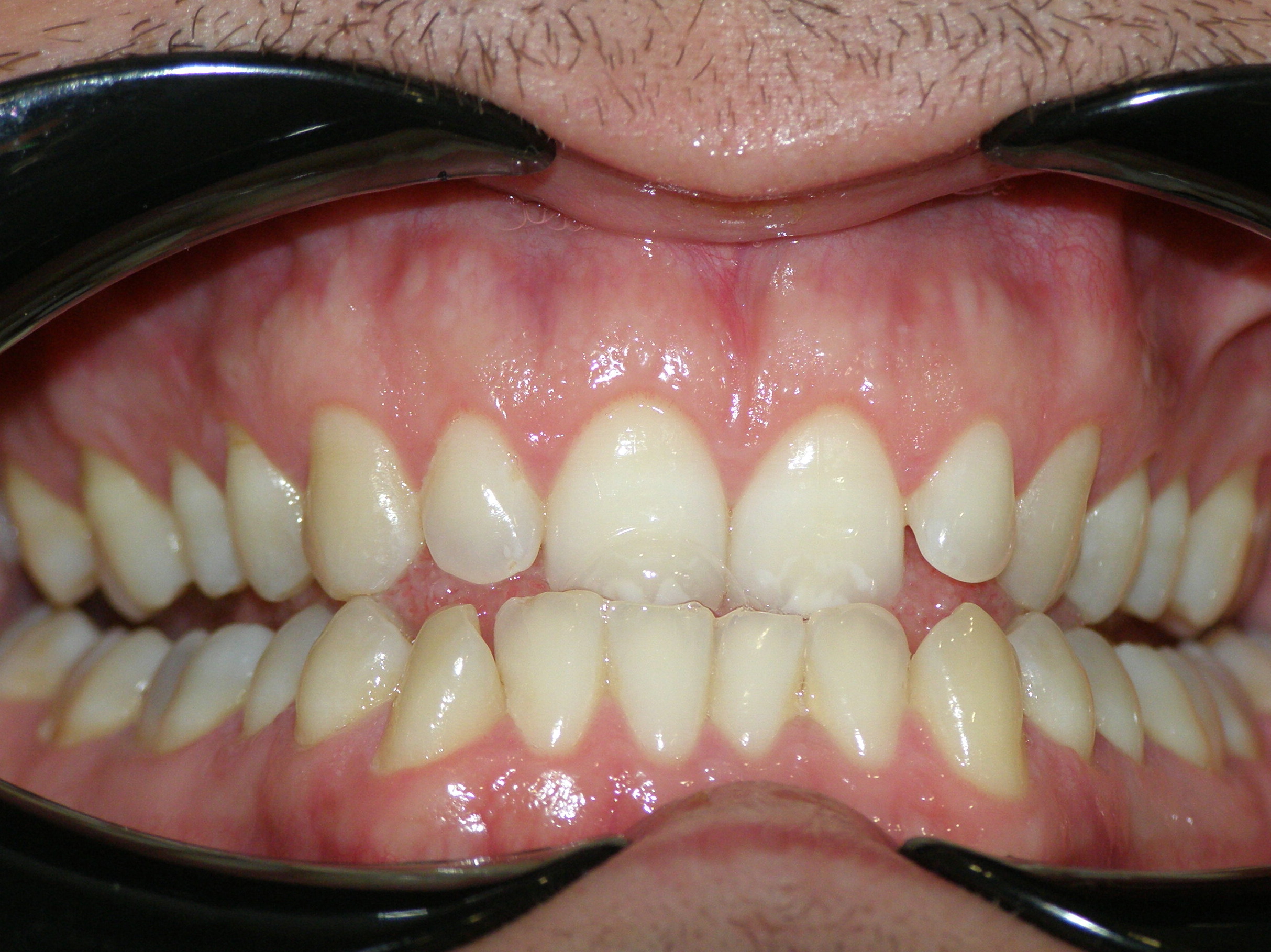 Исправление прикуса брекетами