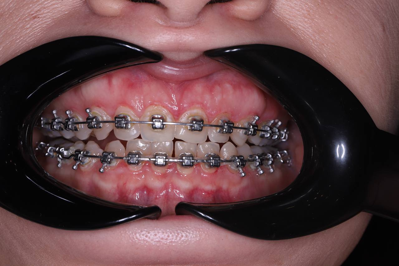 Удлинение клинической коронки зуба