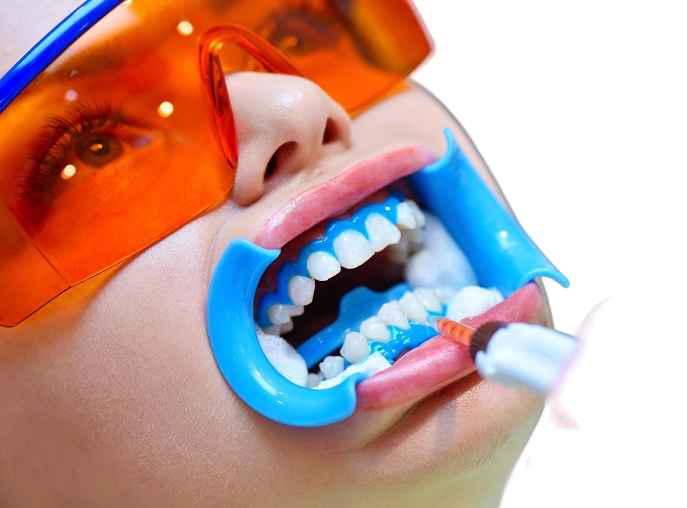 Фторирование зубов