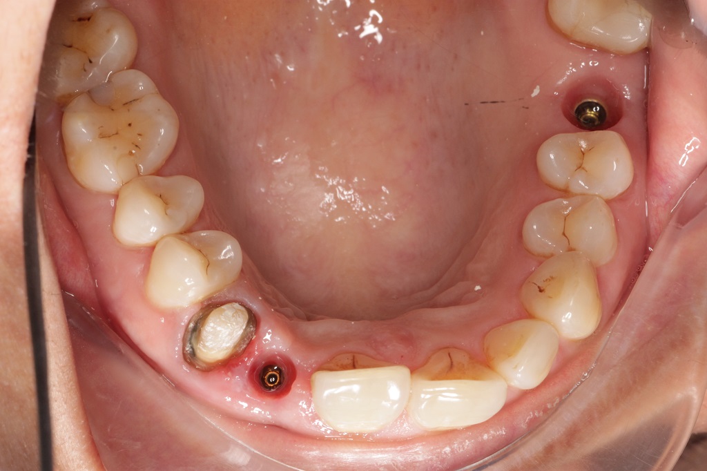 Имплантация зубов