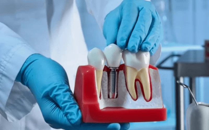 Есть ли вред от зубных имплантов