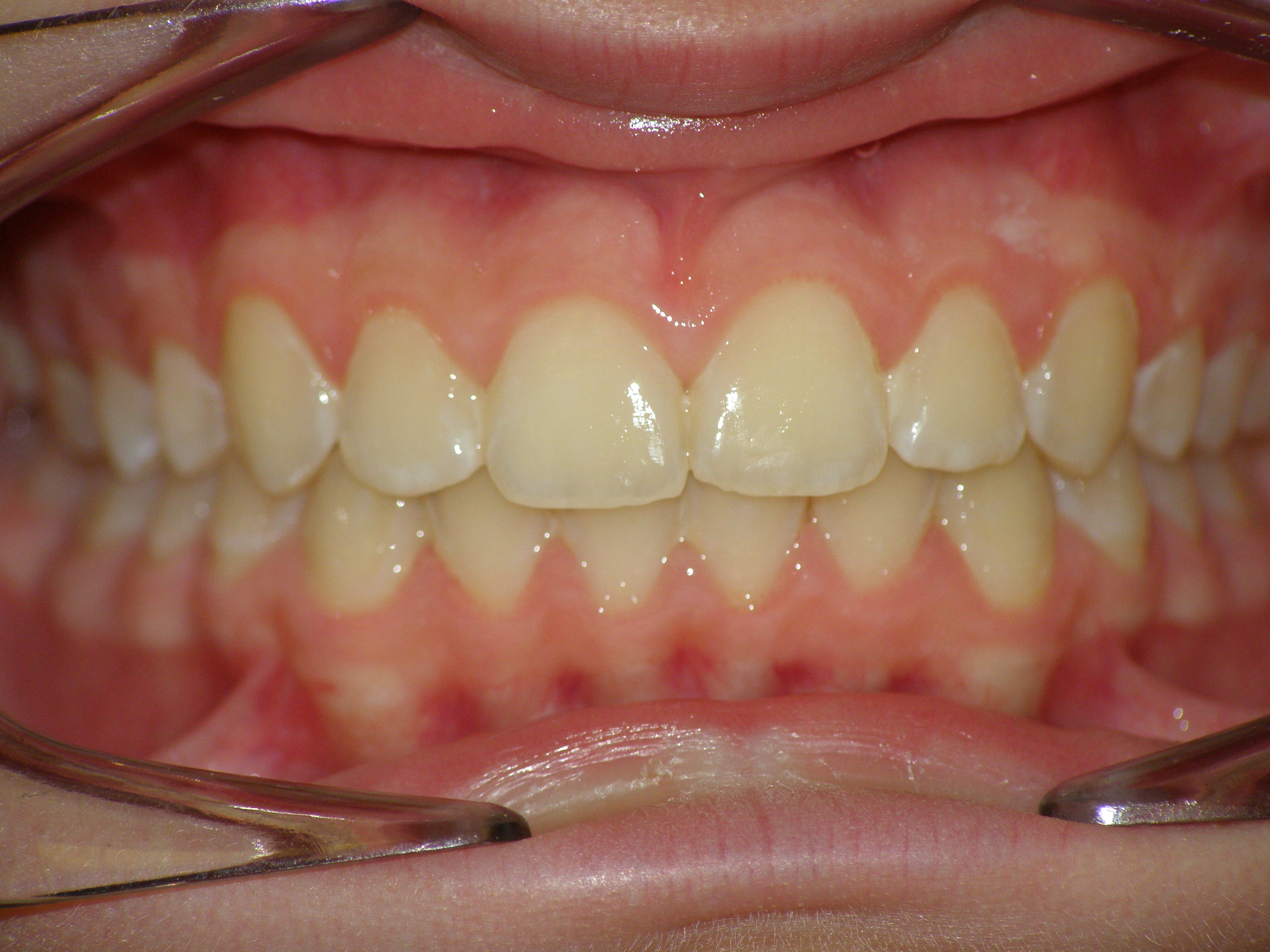 Исправление прикуса брекетами