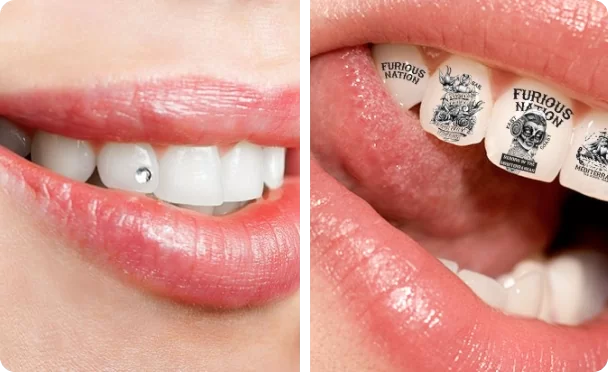 Снятие зубных украшений