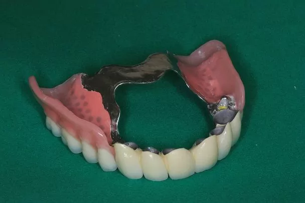 Бюгельное протезирование