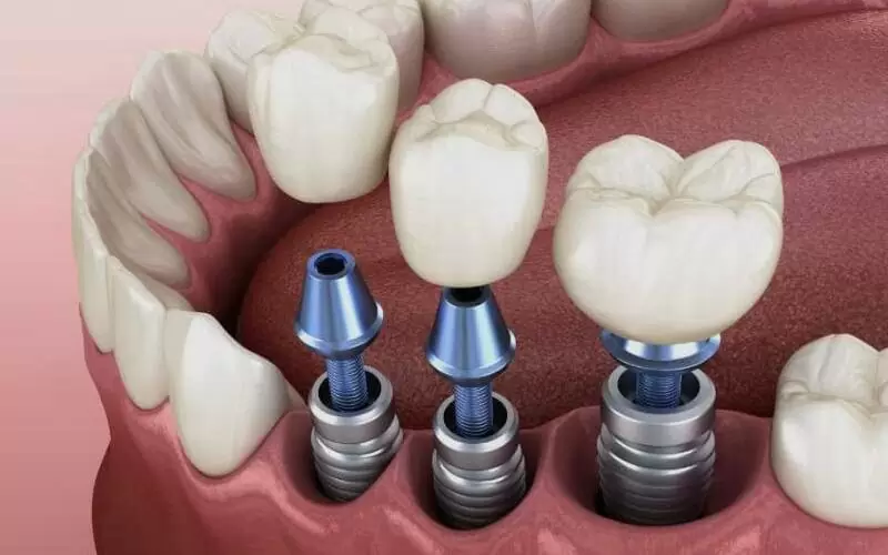 Сколько длится приживление зубных имплантов