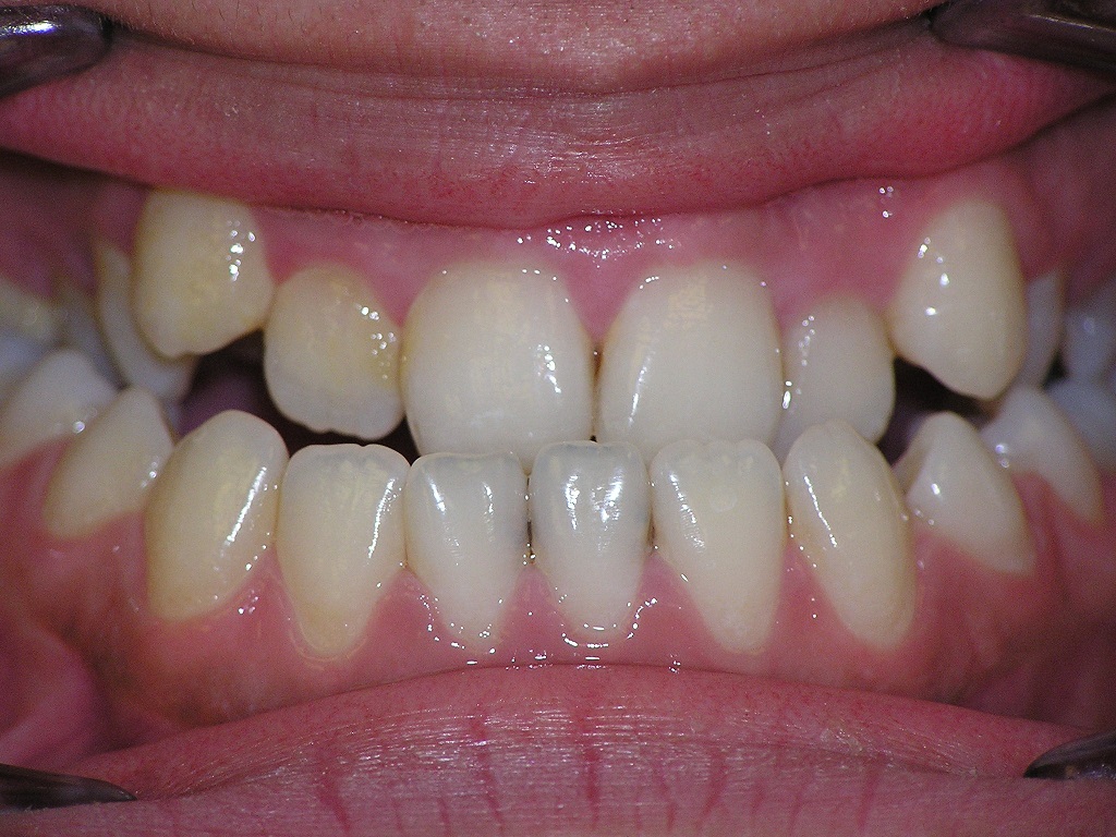 Исправление прикуса