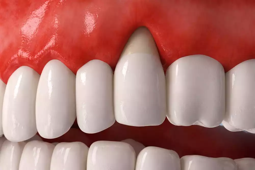 Оголение шейки зуба: причины и как остановить процесс