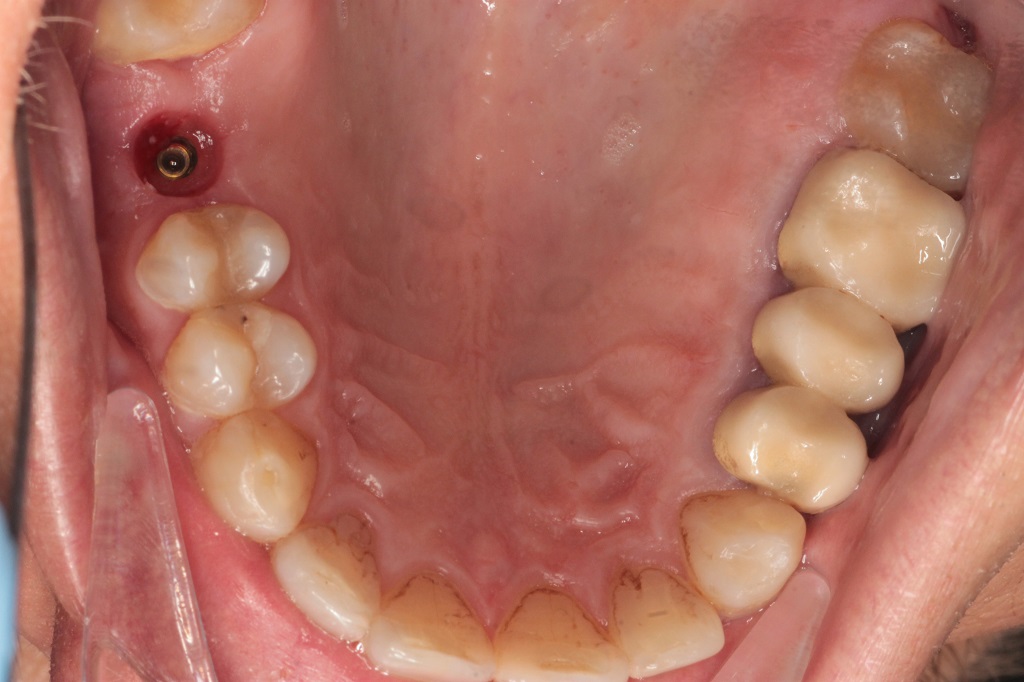 Имплантация зуба