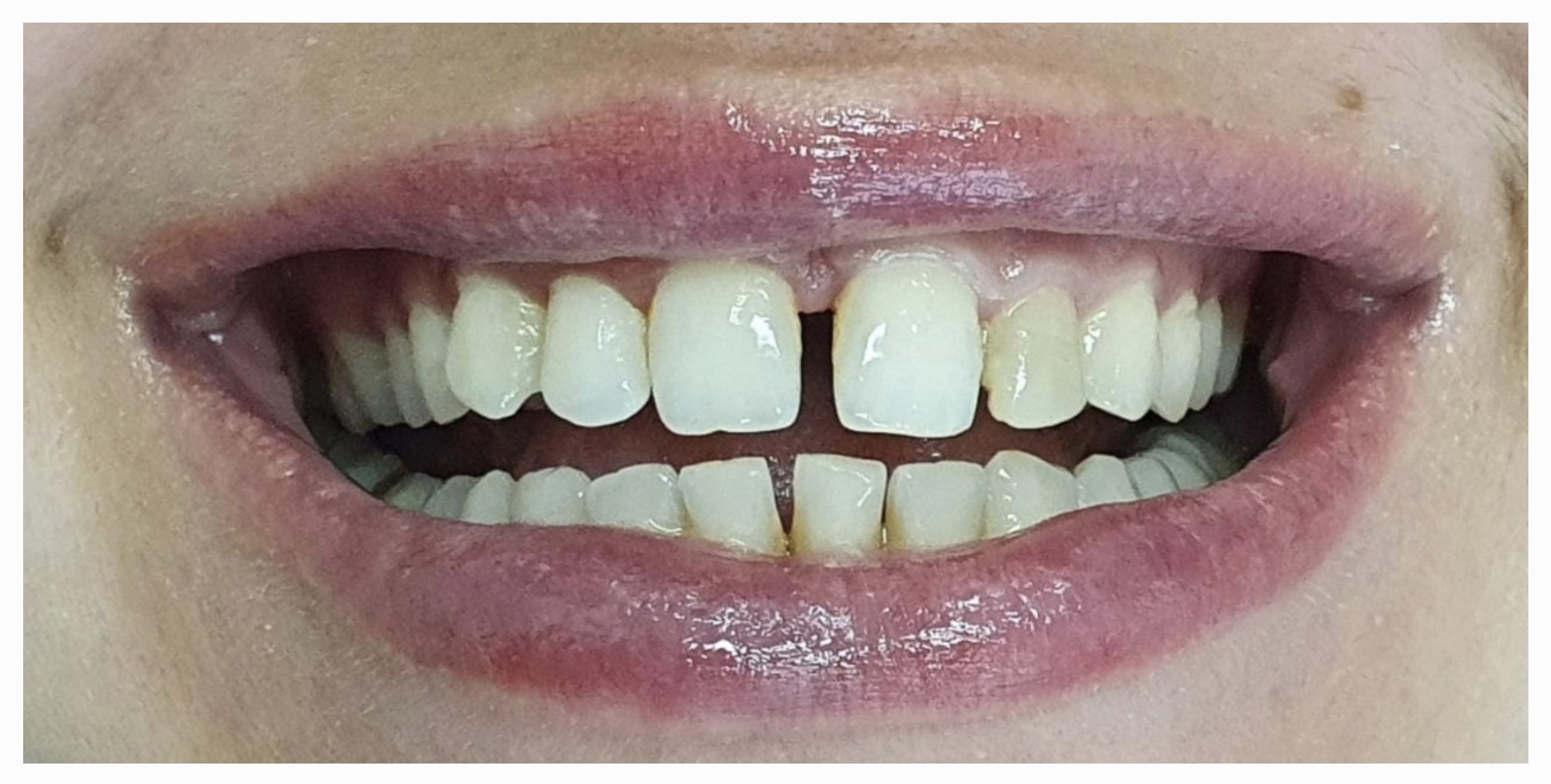 Композитные виниры