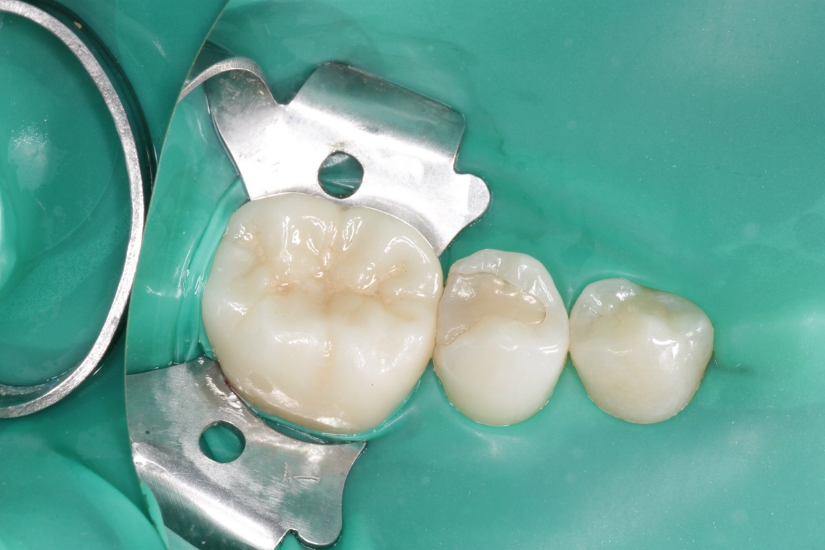 Лечение кариеса