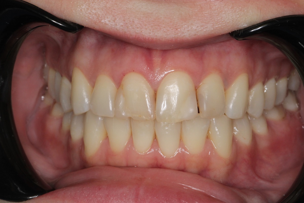 Керамические виниры