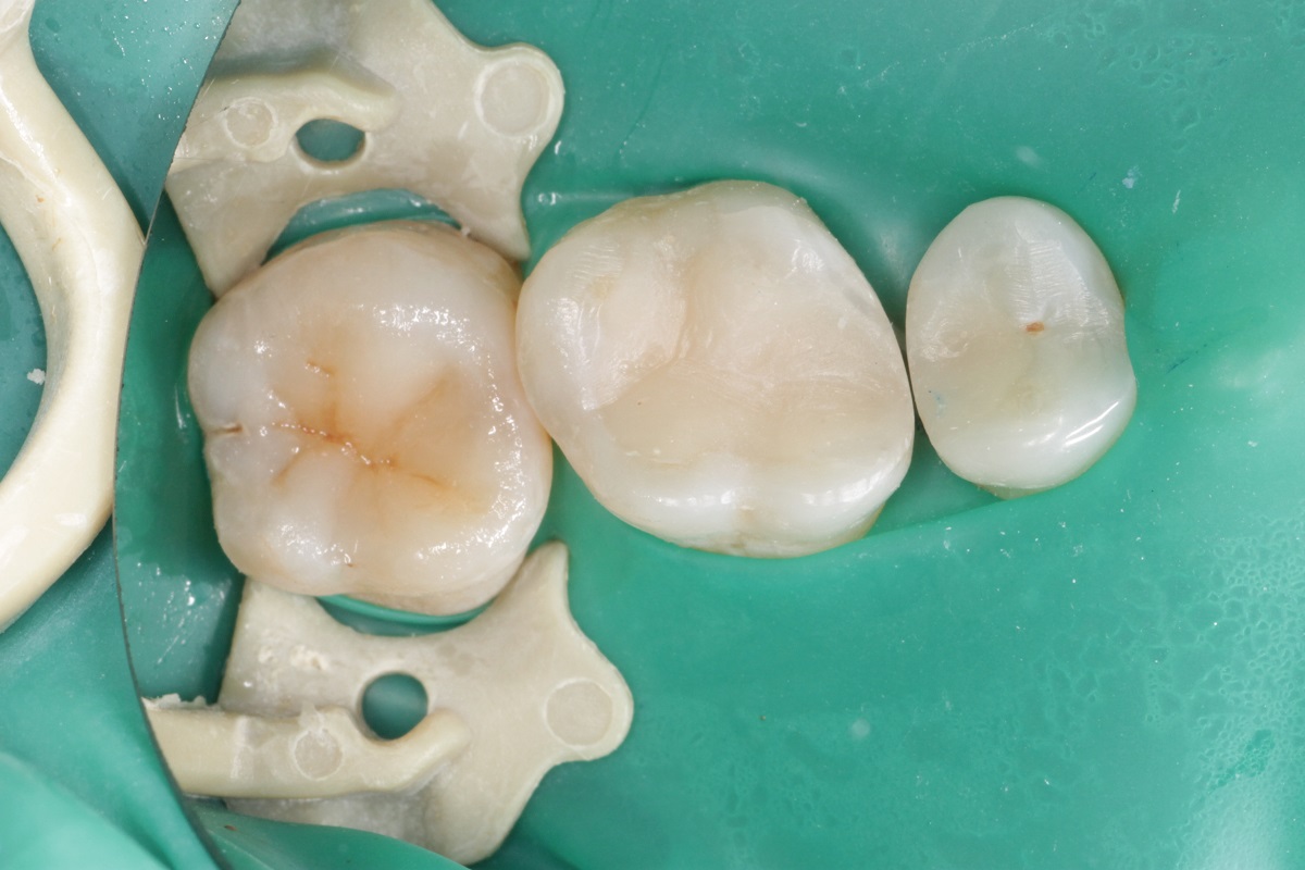 Лечение кариеса