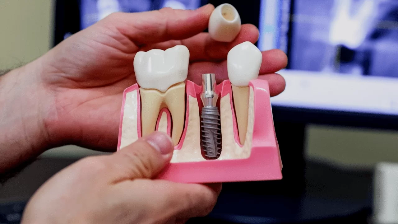 Что делать, если сломался зубной имплант: срочная помощь и рекомендации