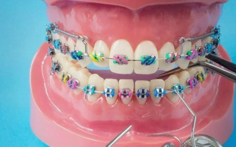 Как убрать щель между зубами