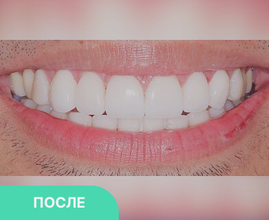 Виниры установка недорого - стоимость от 7500 руб. E-MAX - 25000 руб ...