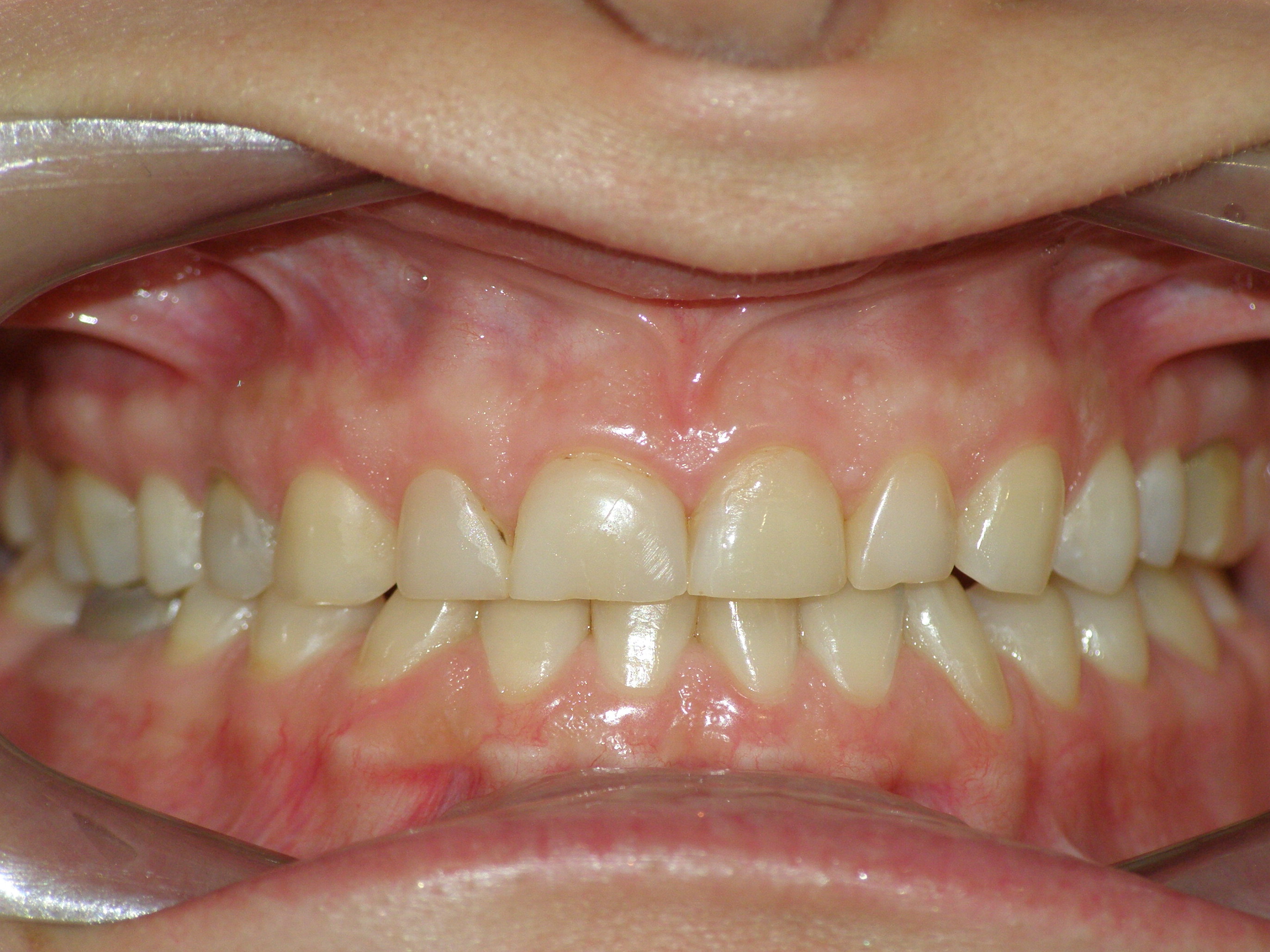 Исправление прикуса брекетами